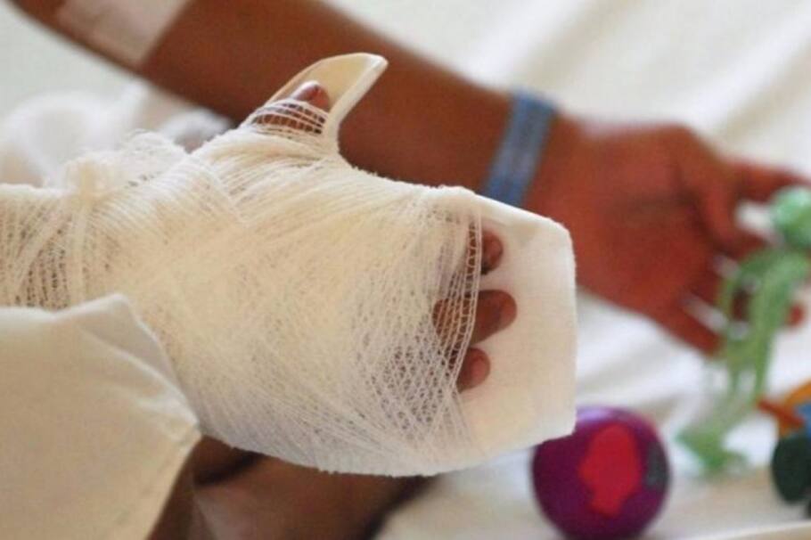 Actuar mal cuando alguien se quema con pólvora puede agravar la lesión y generar complicaciones serias.