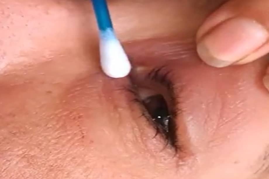 La mujer pudo recuperarse después de recibir tratamientos con calor y extraer el gusano con pinzas.