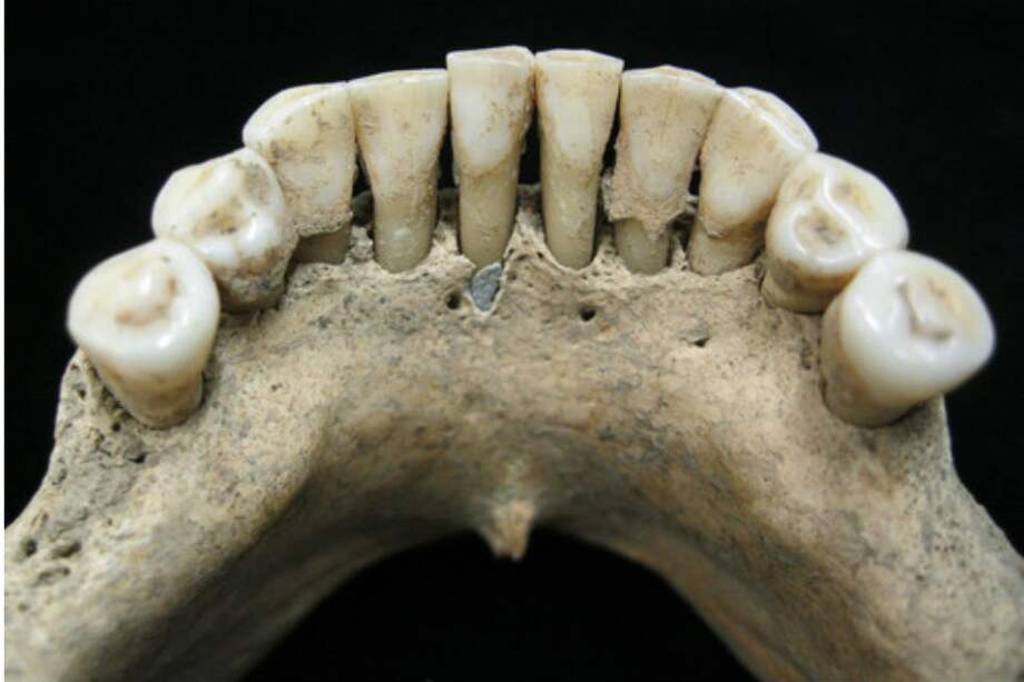 Pigmento de lapislázuli atrapado en el cálculo dental de la mandíbula inferior de una mujer medieval. / Christina Warinner