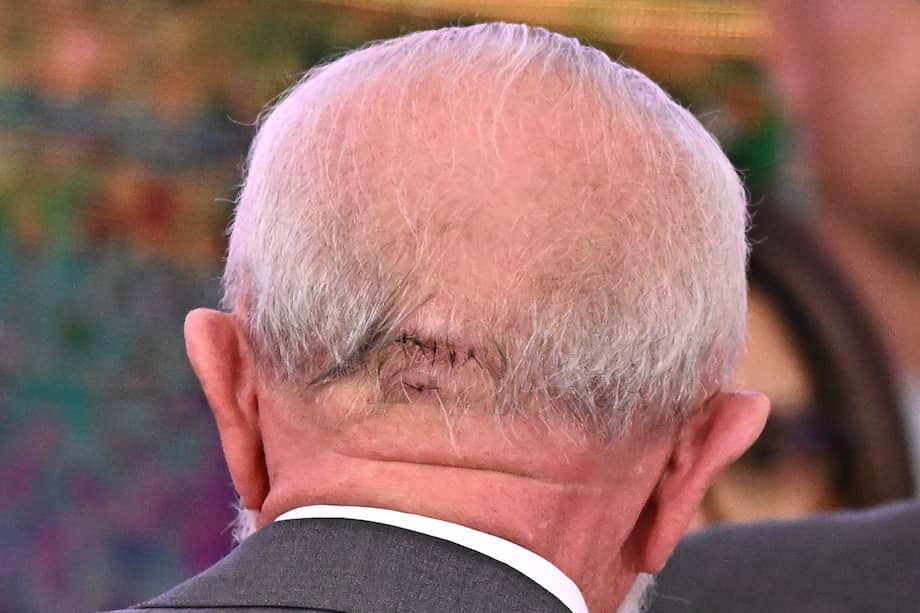 El 19 de octubre, Lula da Silva se cayó en el baño de la residencia oficial y se golpeó la parte trasera de la cabeza contra el suelo. Recibió puntos de sutura y evaluaciones periódicas durante varias semanas.