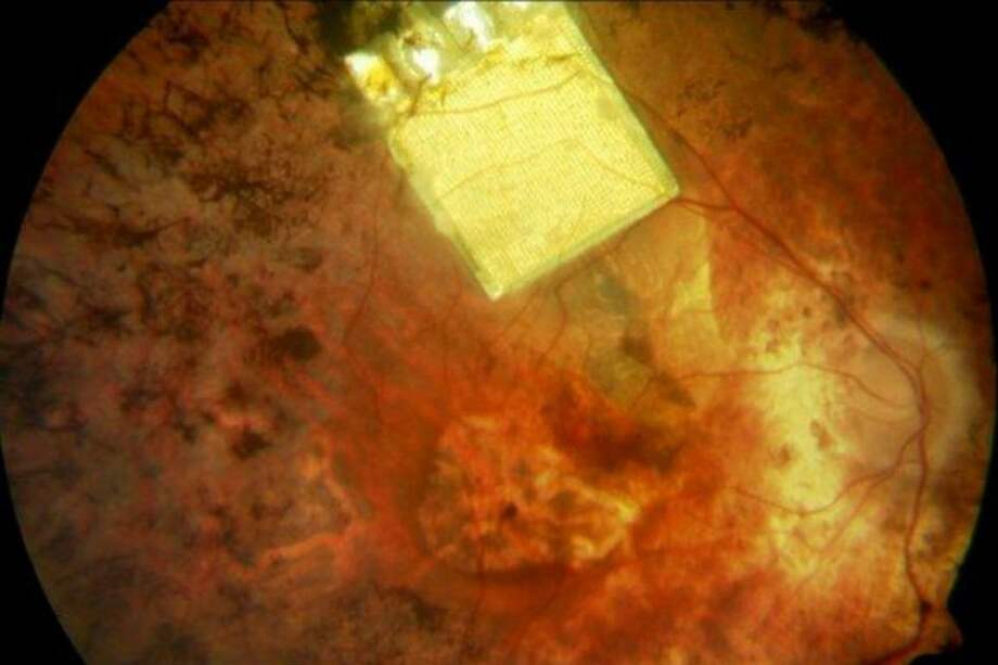 Implantan chips que devuelven la visión a pacientes ciegos
