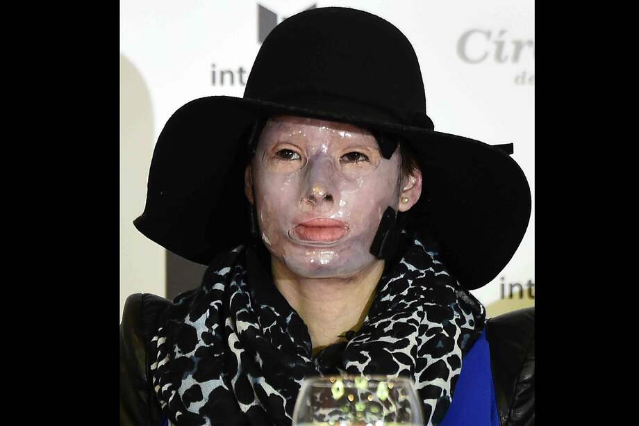 Natalia Ponce de León, durante su primera aparición publica después de ser atacada con ácido. /Luis Acosta - AFP