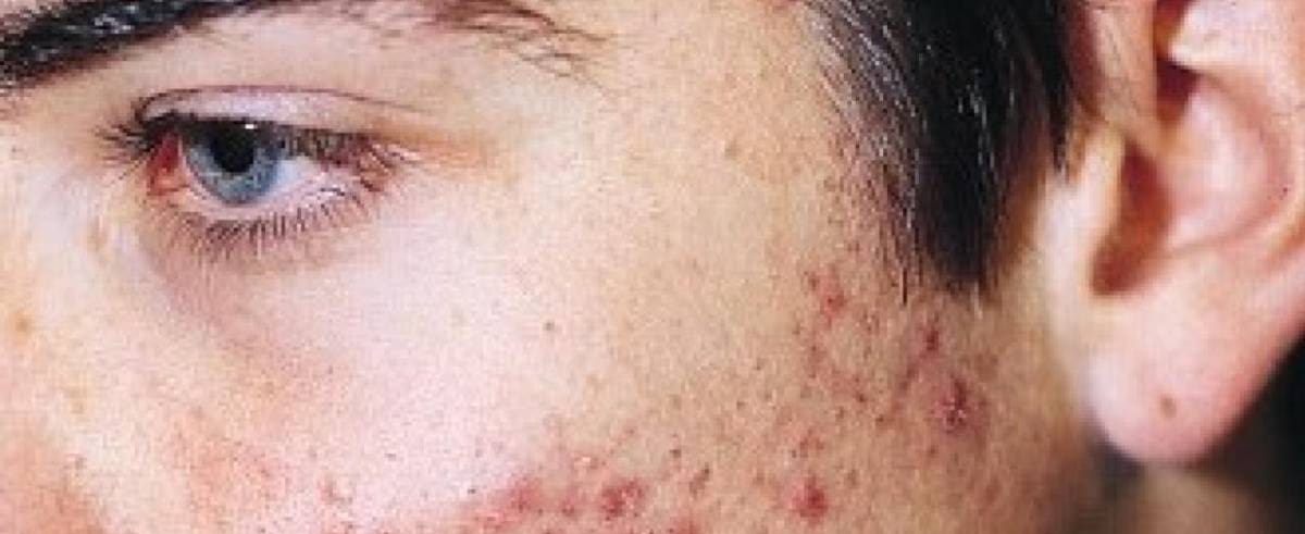 Soñar que tengo acné