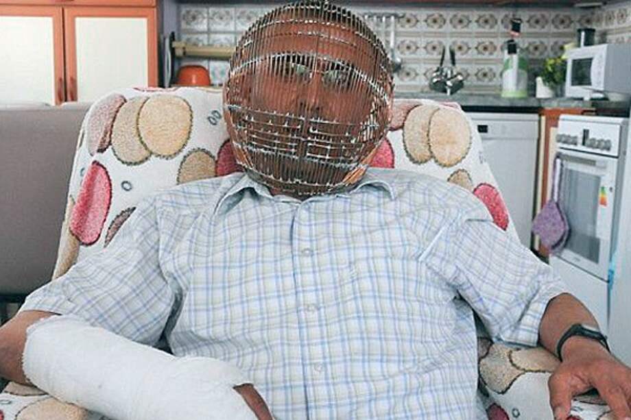 Hombre enjauló su cabeza para lograr dejar de fumar