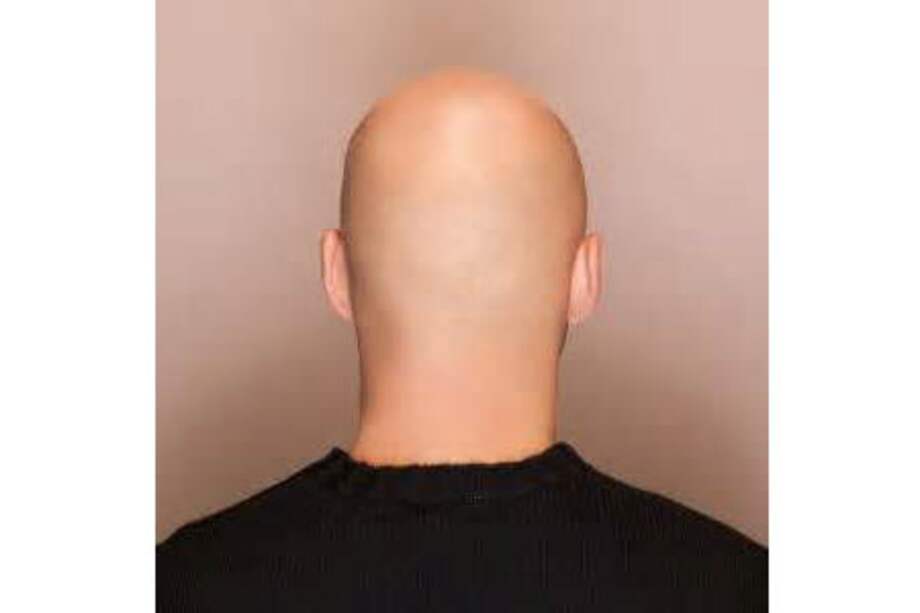 La esperanza contra la calvicie