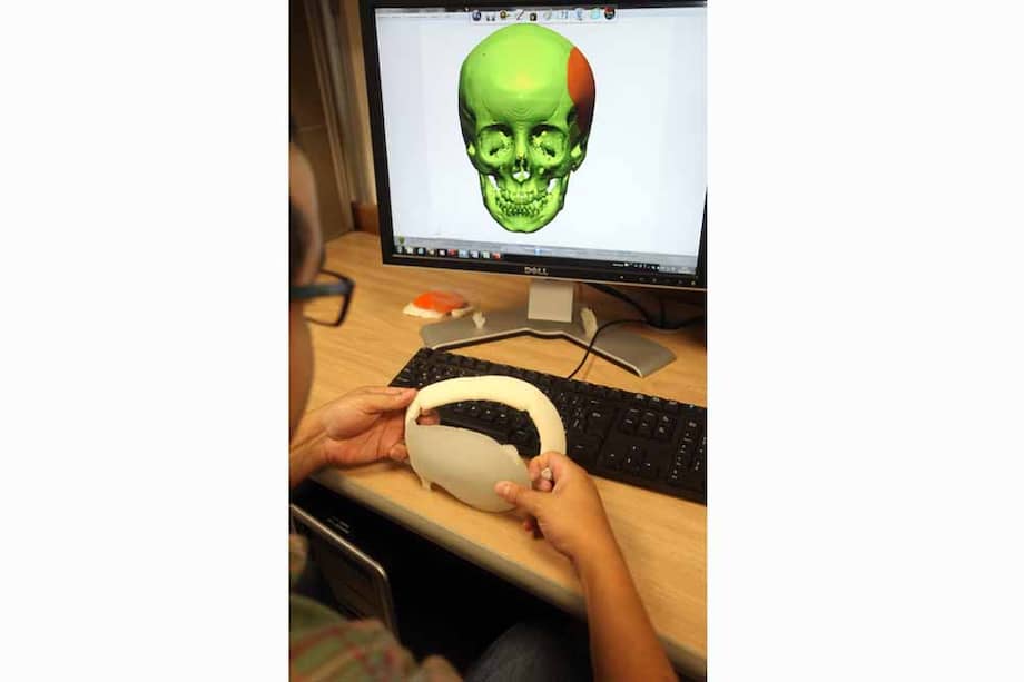 La empresa SmartBone realiza simulaciones en 3D de la prótesis que fabricarán a la medida del paciente. / Robinson Henao