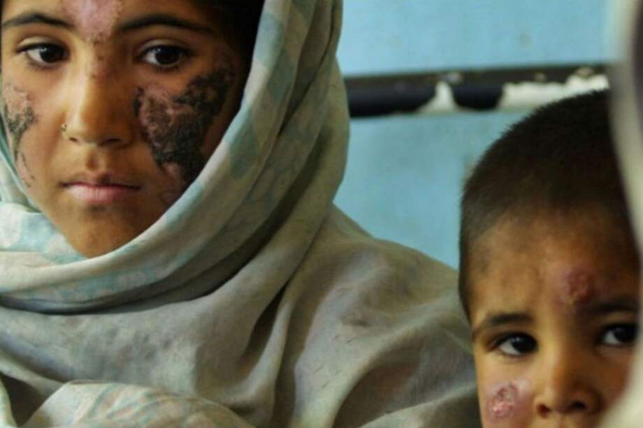 Según la Organización Mundial de la Salud, hay tres formas principales de leishmaniasis: visceral (la forma más grave de la enfermedad, a menudo conocida como kala-azar), cutánea (la más común) y mucocutánea. / Página oficial de la OMS