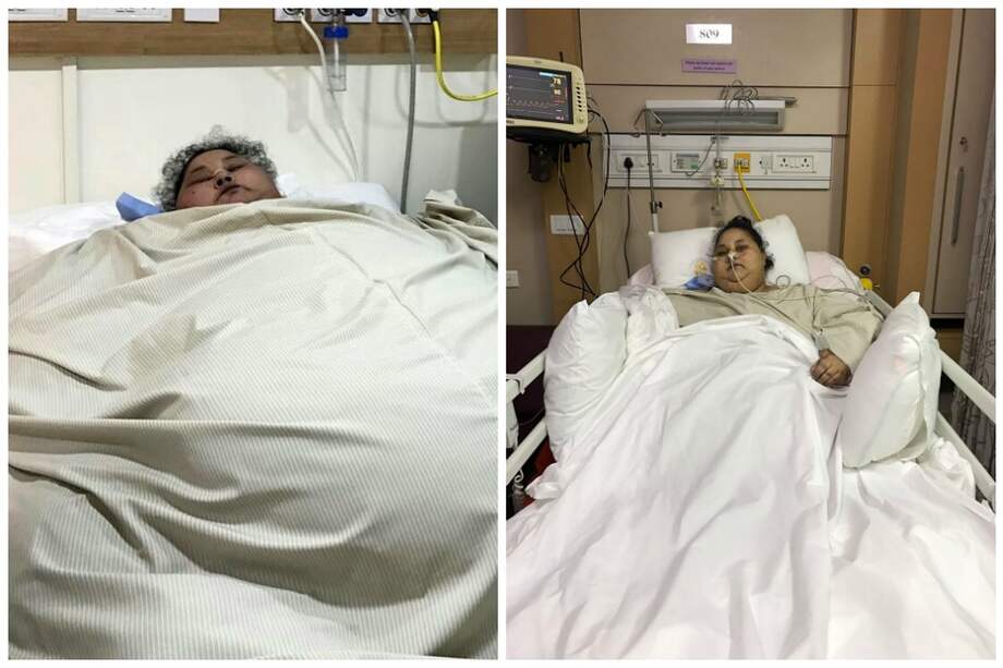 Eman Ahmed Abd El Aty, antes y después de la cirugía. / AFP