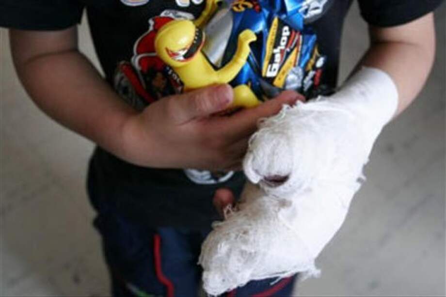 Se registraron 832 casos de quemados con pólvora en las fiestas de fin de año