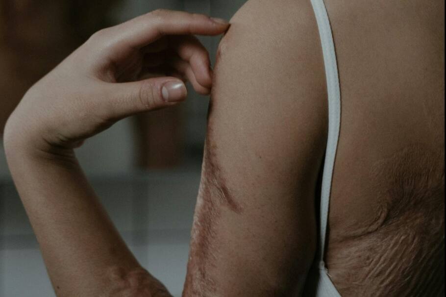 Al intentar encender una chimenea con etanol, la comunicadora se quemó el 23% de su cuerpo: "cuanto más pasa el tiempo, más duele”, dijo. Así avanza su recuperación.