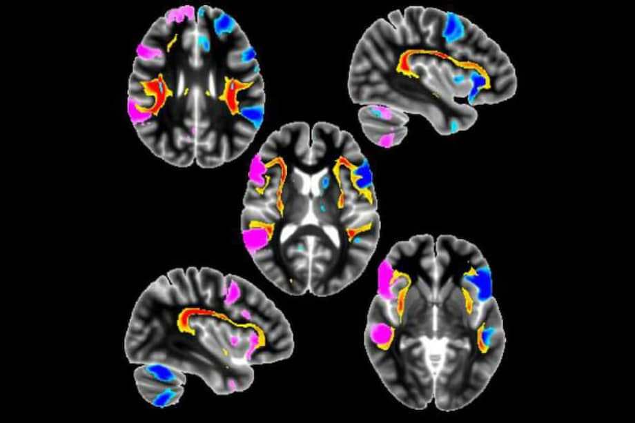 A disposición de los científicos estaban los datos de aproximadamente 500 mil personas, incluidos los resultados de los exámenes de resonancia magnética funcional de 9,000 personas y análisis de 400 mil personas. / G Douaud, University of Oxford, 2019