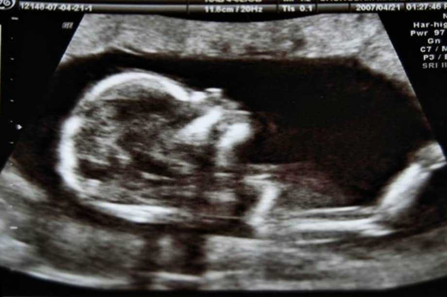 Científicos italianos estudiaron placentas humanas y demostraron la presencia de microplásticos.