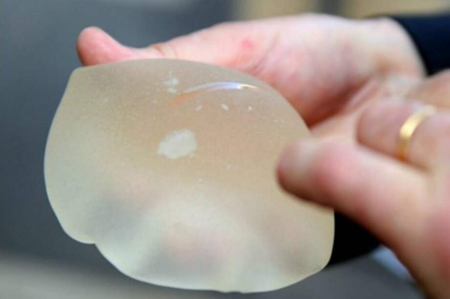 Francia retiró del mercado varias marcas de prótesis mamarias por el riesgo asociado a cáncer. / El Espectador