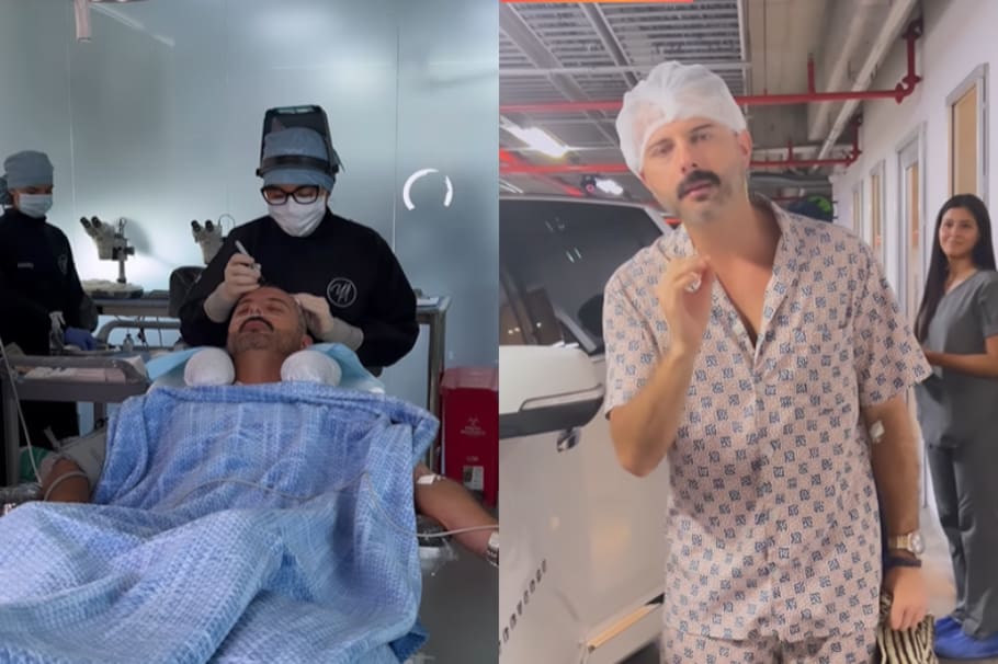 El actor, Mario Espitia, quien interpreta a Arturo en Leandro Díaz, decidió someterse a un implante capilar para cambiar su aspecto físico.