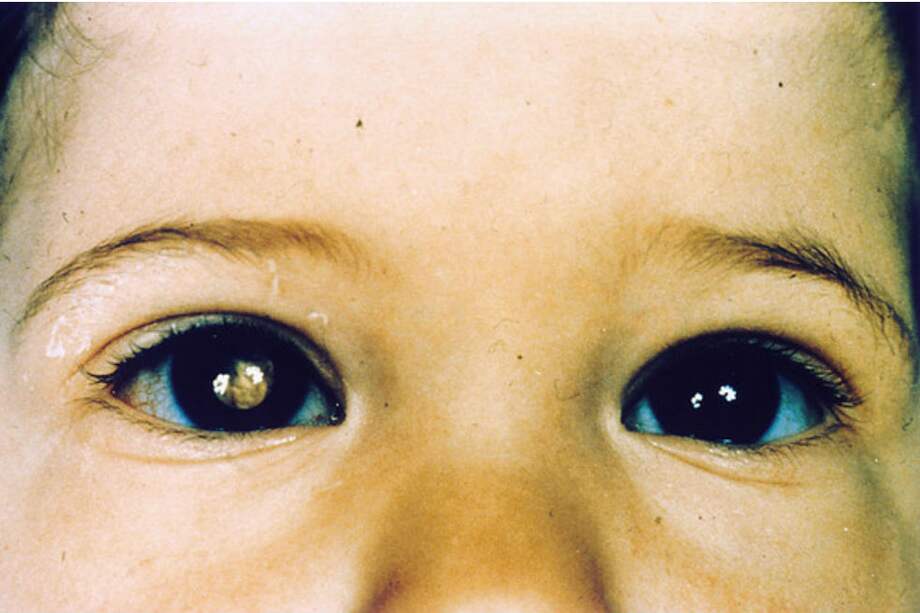 Niño con retinoblastoma. / / Wikicommons