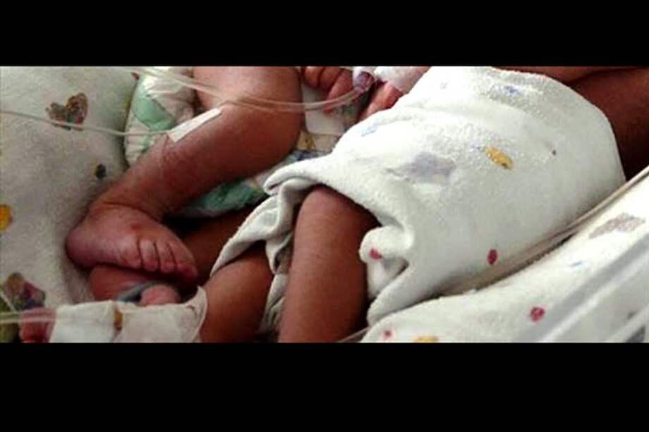 Nacen en Paraguay siamesas unidas por el tórax