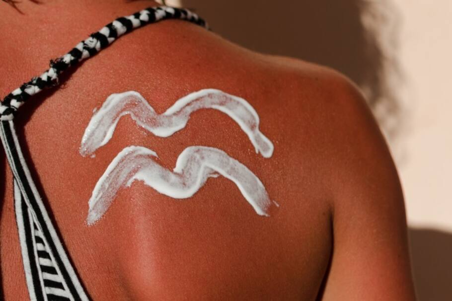 ¿Cómo curar las quemaduras del sol?