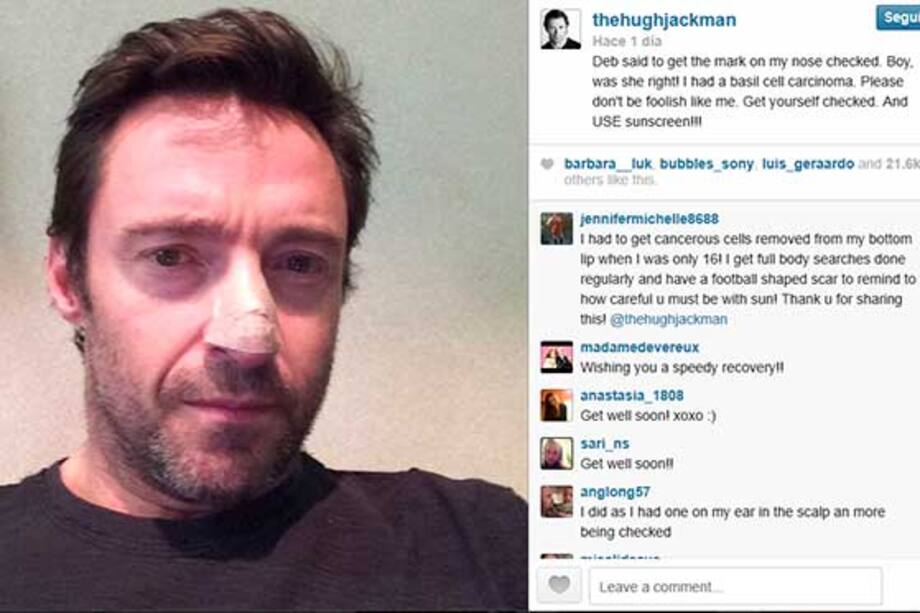 El actor Hugh Jackman tiene cáncer de piel