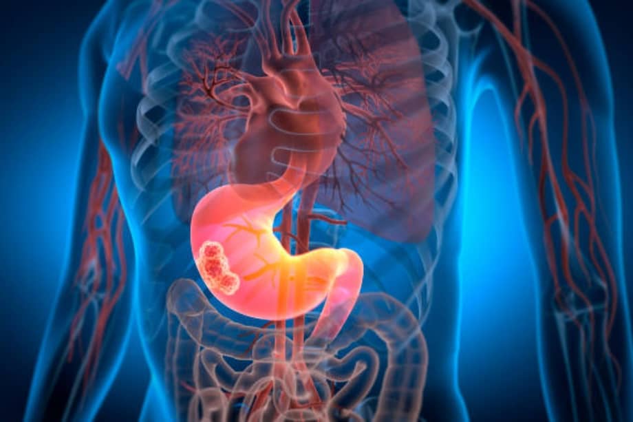 El cáncer de páncreas es uno de los más letales.