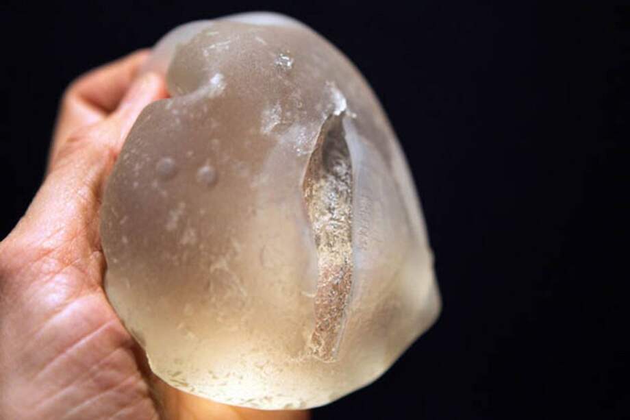 Brasil prohíbe importación de prótesis mamarias de la marca francesa Arion