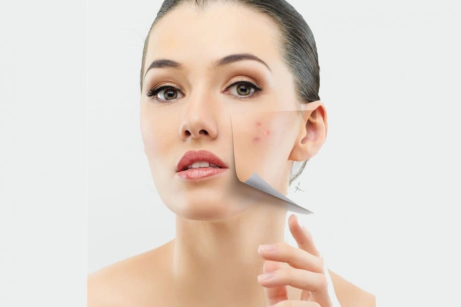 Mitos y verdades sobre el acné