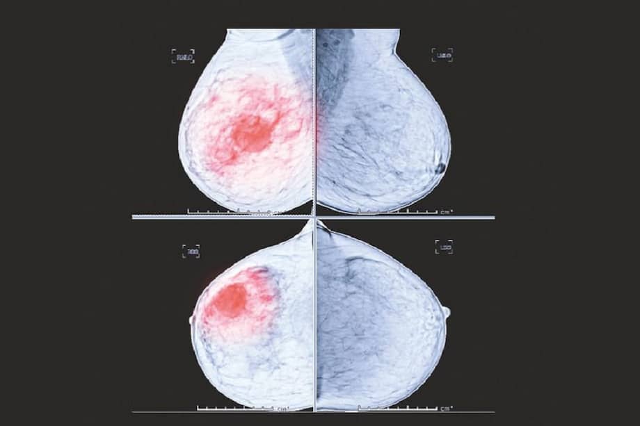 Cáncer de mama.