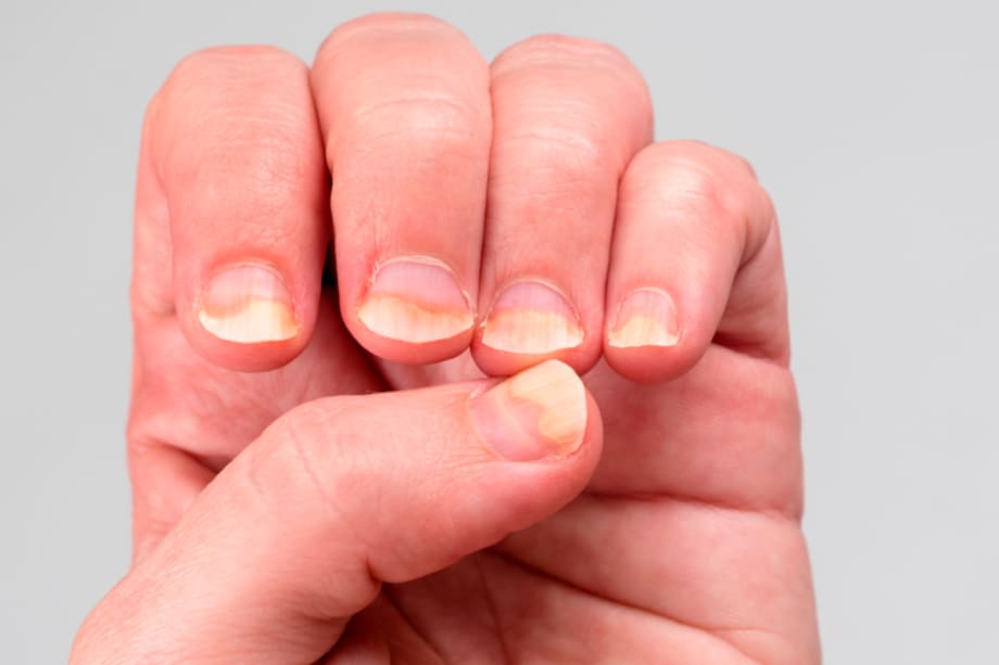 Si tus uñas están amarillas, debes consultar al médico.