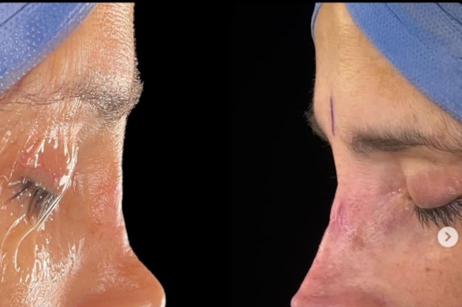 Dorismar tras su procedimiento estético.