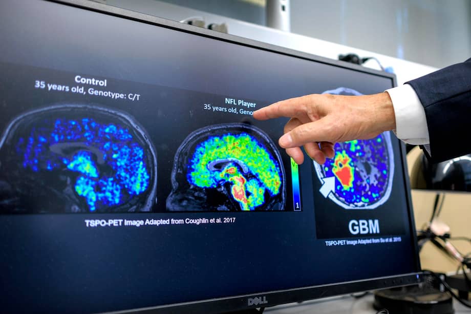 Imagen de referencia que muestra investigadores del Florida International University en Miami señalando biomarcadores de la enfermedad de Alzheimer.