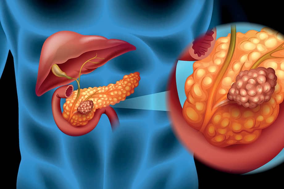 El cáncer de páncreas no es común, pero suele ser mortal.