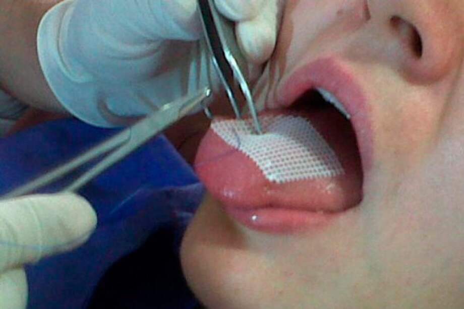 Alerta en Bogotá por utilización de malla adelgazante