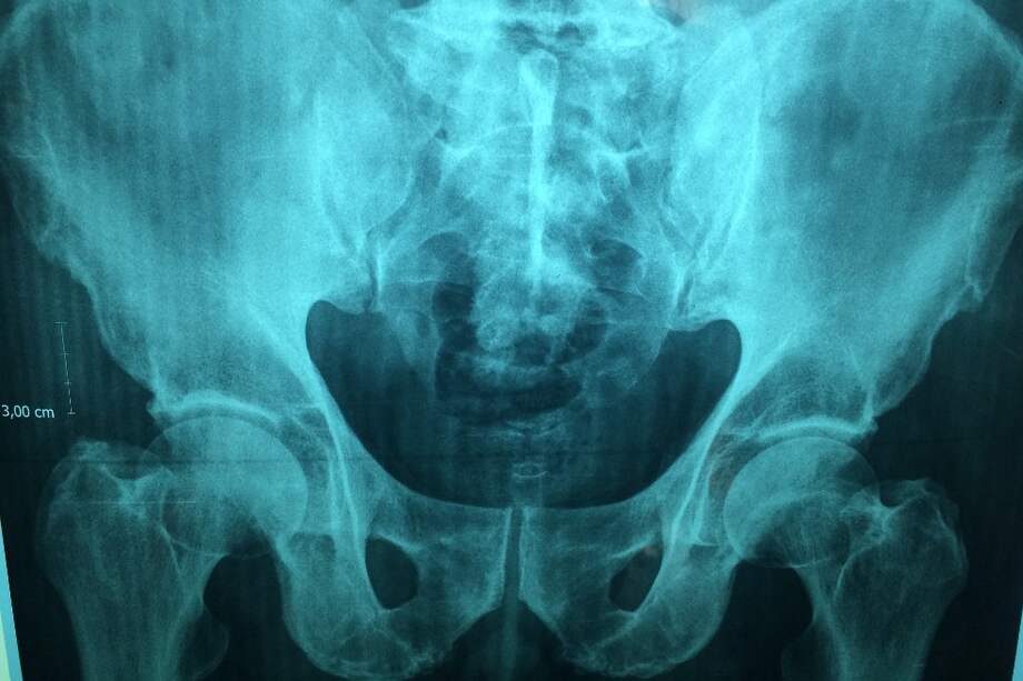 El caso se registró en un hombre de 77 años de Tokio. Se presentó días después de que se diera su alta médica.