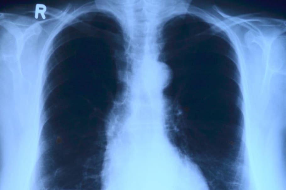 Un edema pulmonar no es algo grave si se trata a tiempo, pero en ciertos casos puede llegar a ser mortal.