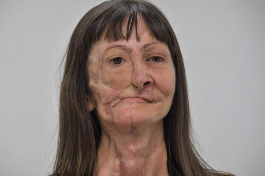 Así quedó el rostro de Denise Vicentin luego de que le fuera instalada la prótesis. / AFP