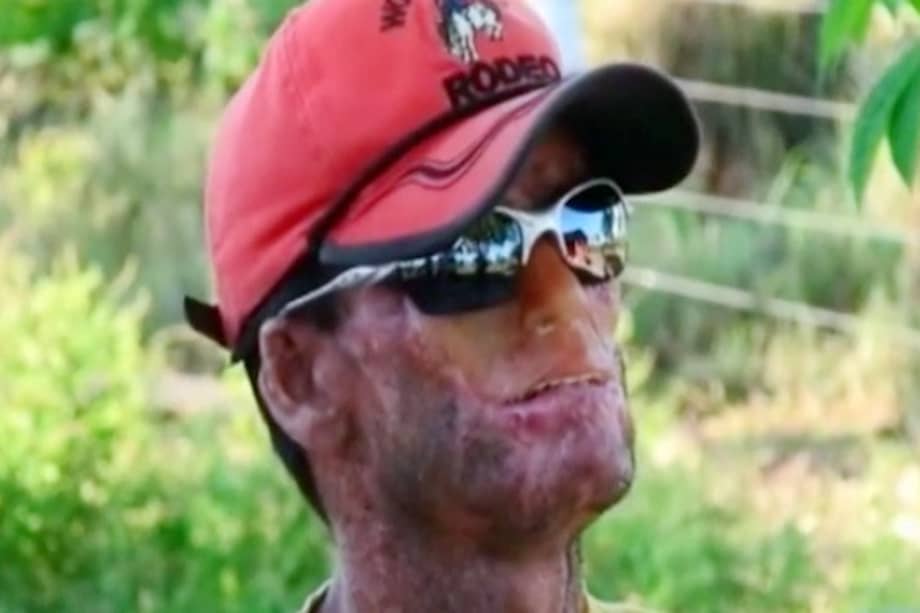 Extraña enfermedad 'carcome' la piel de los habitantes en un pueblo de Brasil