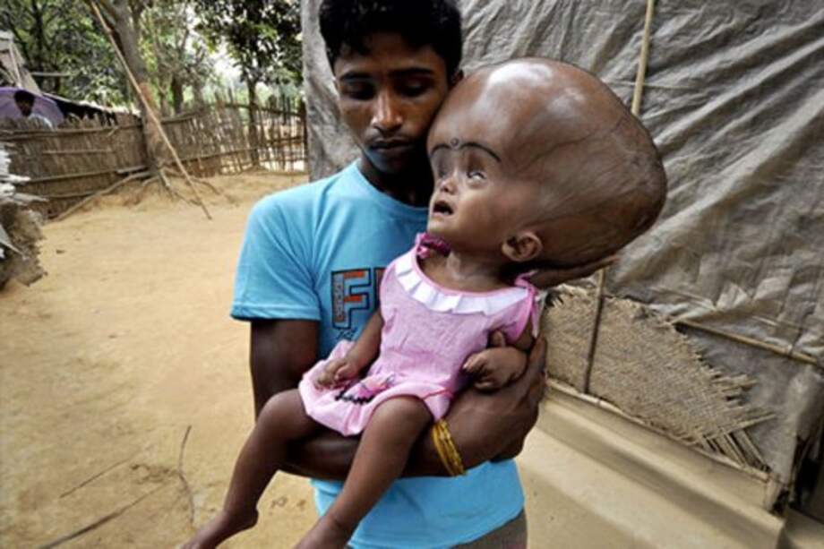 Operan de nuevo a niña afectada por hidrocefalia en India