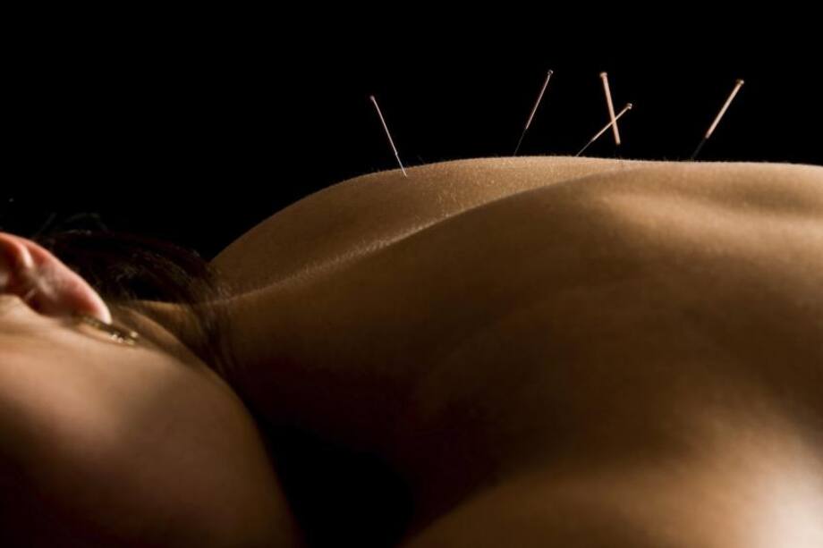 Cuatro beneficios de la acupuntura