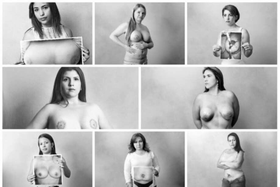 En la edición del 2 de junio de El Espectador, varias mujeres víctimas de cirugías decidieron mostrar sus cicatrices. / Cristian Garavito - El Espectador