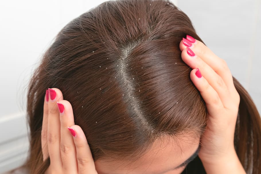 ¿Qué hacer para eliminar la caspa?