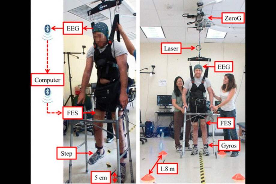 Es la primera vez que alguien con paraplejía por lesión de la médula espinal vuelve a caminar sin depender de extremidades robóticas. / JNER