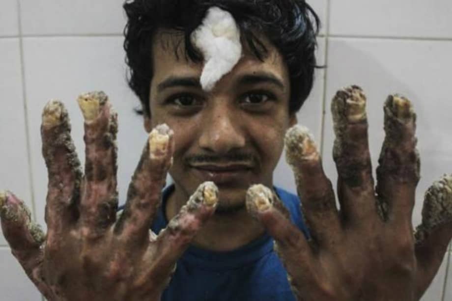 Abul Bajandar, de 27 años, padece una extraña enfermedad llamada epidermodisplasia verruciforme que le impedia tener movilidad en manos y pies. / EFE