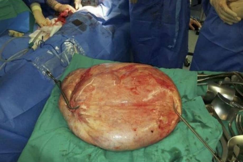 Imagen del tumor benigno de 25 kilos extraído a una mujer en 2013 en el Hospital de Torrevieja (Alicante). EFE/Hospital de Torrevieja
