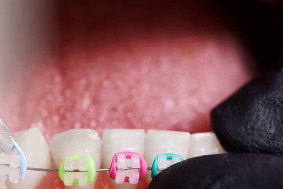 El Invima recuerda que los brackets no son, únicamente, un procedimiento estético.