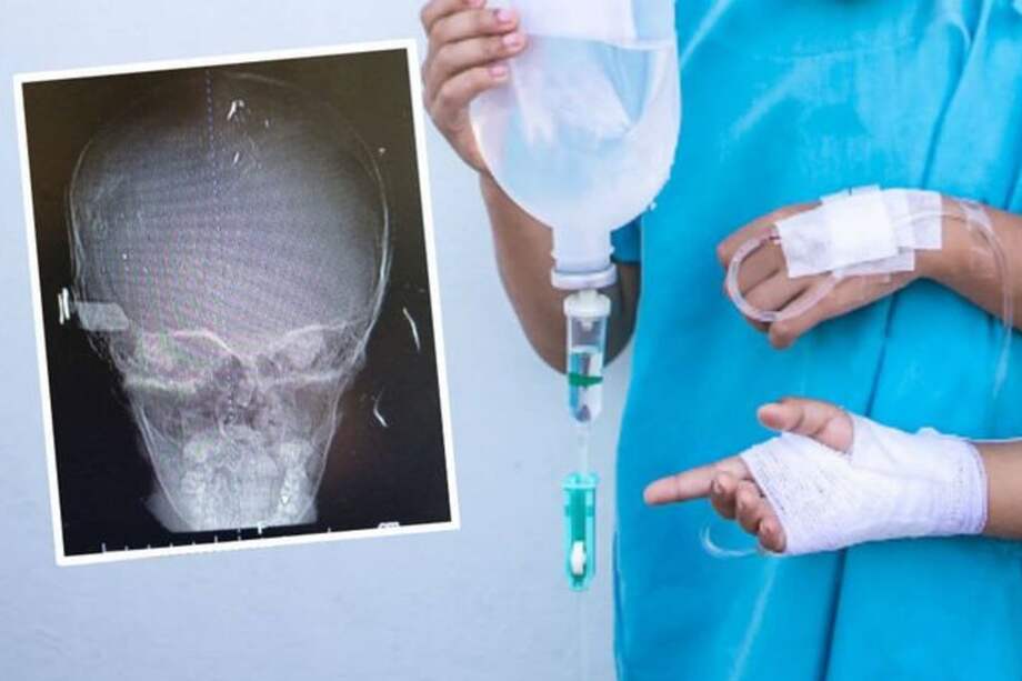 La Fibrodisplasia Osificante Progresiva hace que el tejido muscular y conectivo se está endureciendo como si fueran huesos.