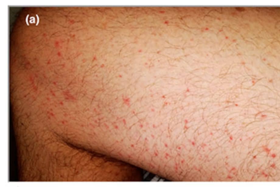 Los primeros en reportar lesiones en la piel de personas con el virus hacen parte de un grupo de investigadores chinos que describieron las características de 1.099 pacientes de 522 hospitales.