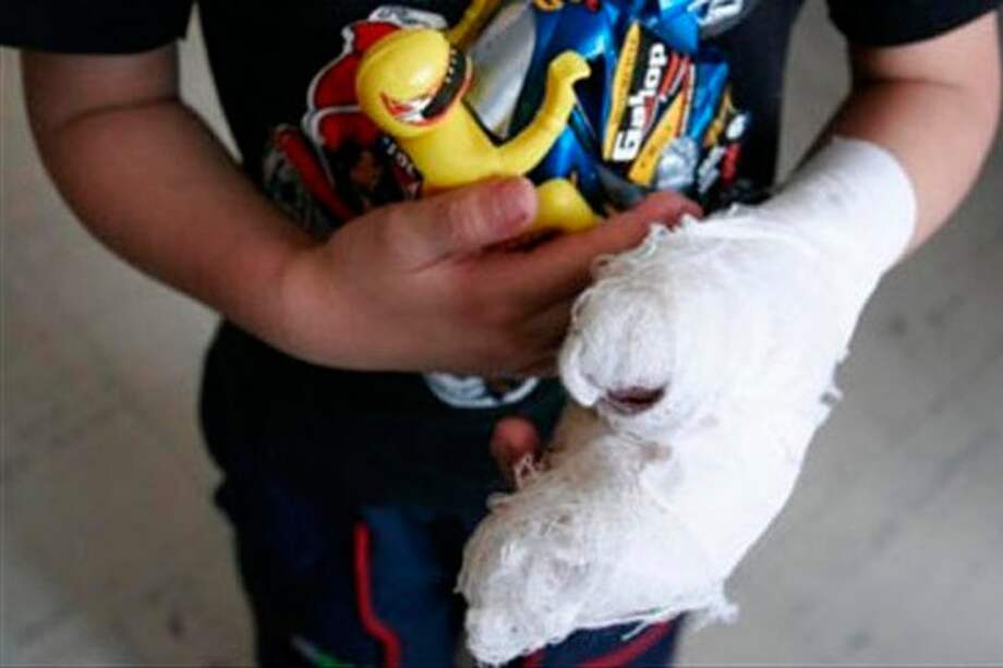 Uno de los quemados es un menor de 12 años que resultó lesionado por manipular un tote.
