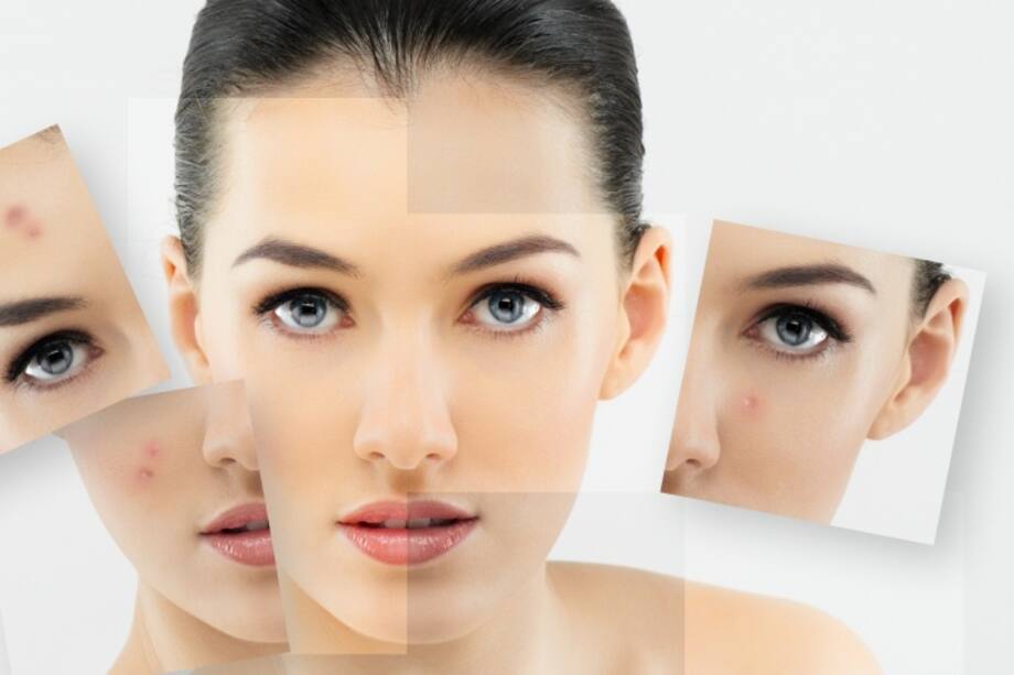 El acné en la edad adulta