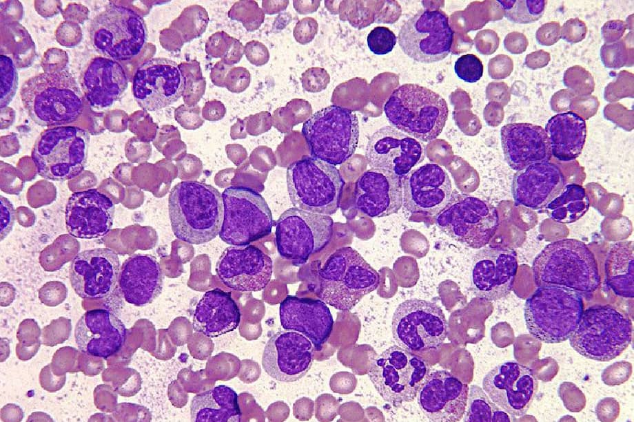 En la leucemia linfocítica crónica hay demasiadas células madre sanguíneas convertidas en linfocitos anormales en lugar de glóbulos blancos sanos. Vista microscópica de la enfermedad./ Flickr