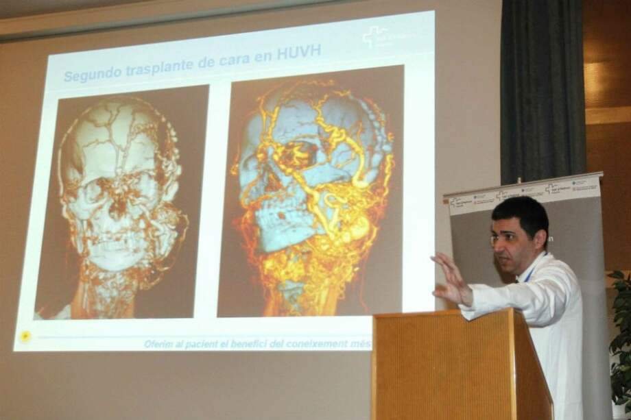 El doctor Joan Pere Barret explicó que el individuo había sido valorado con anterioridad en otros hospitales internacionales, donde se le consideró inoperable. /EFE