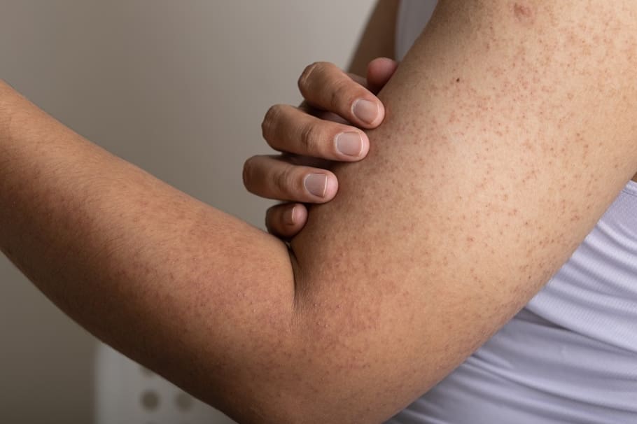 La queratosis pilaris afecta a un gran porcentaje de la población mundial.